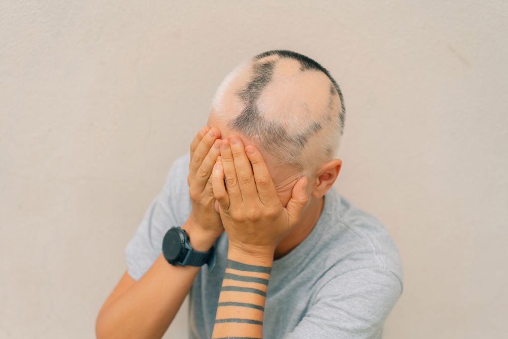 Alopecia areata