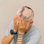 Alopecia areata