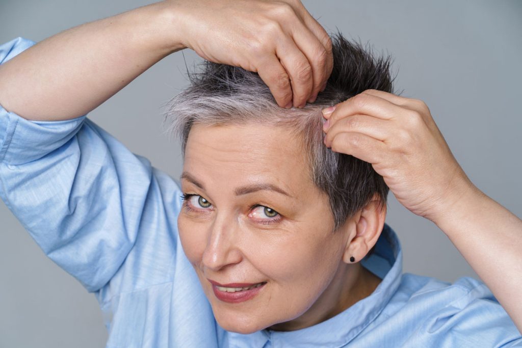 Alopecia en mujeres