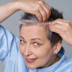 Alopecia en mujeres