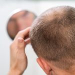 Causas de la alopecia