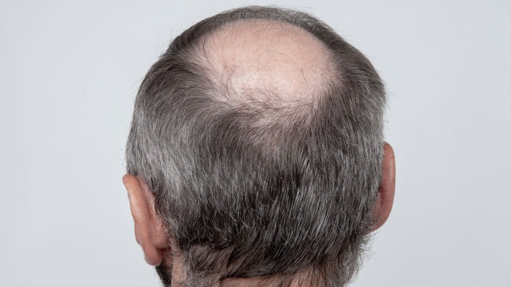 Causas de la caída del cabello