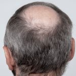 Causas de la caída del cabello
