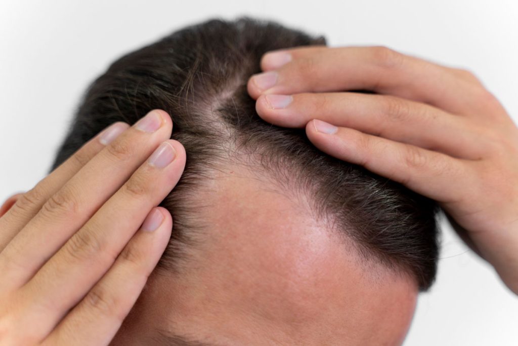 Síntomas de la alopecia