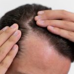 Síntomas de la alopecia