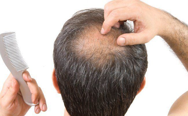 ¿Qué es la alopecia areata y a quién afecta?