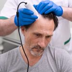 Tratamientos para la alopecia